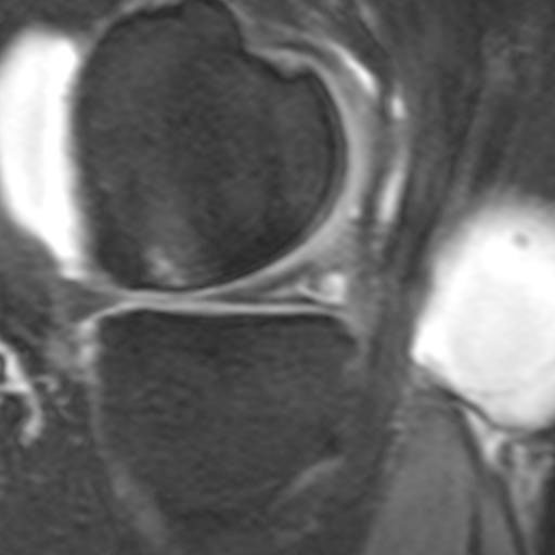 Typischer, grosser Meniskusriss im MRI (Magnetresonanztomographie)